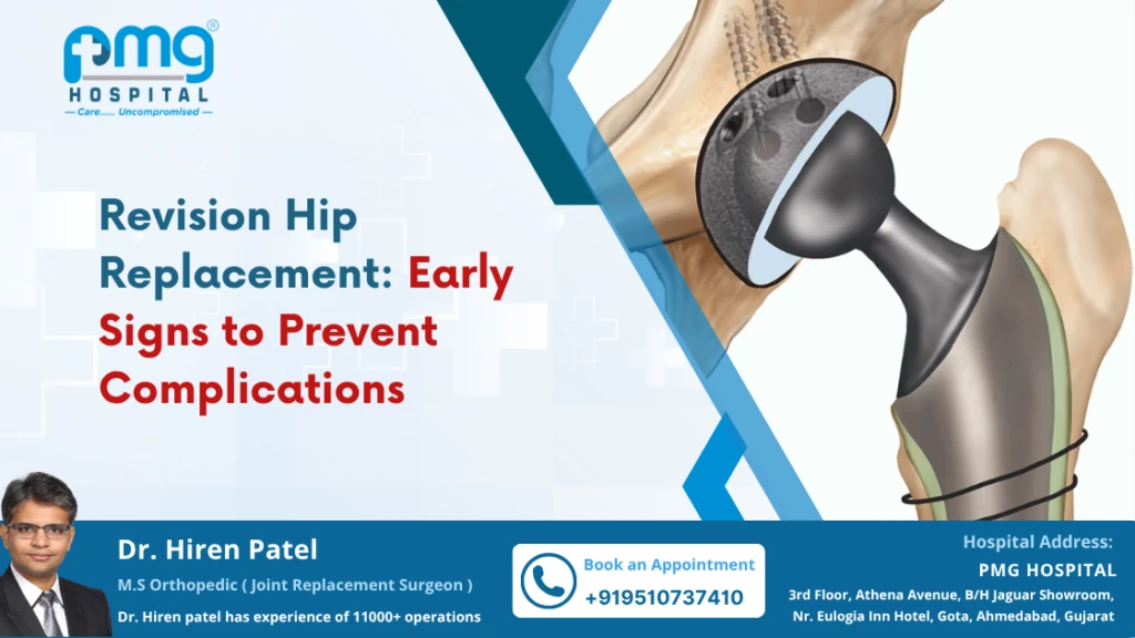 Revision Hip Replacement: Early Signs to Prevent Complications
