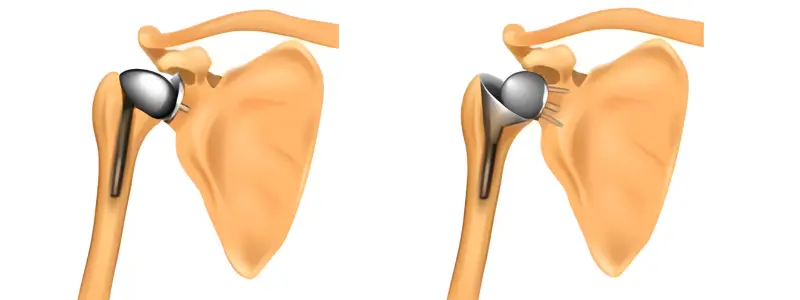 Shoulder Replacement Hospital in Ahmedabad