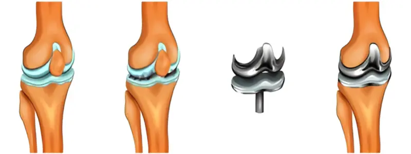 Knee Replacement Hospital in Ahmedabad